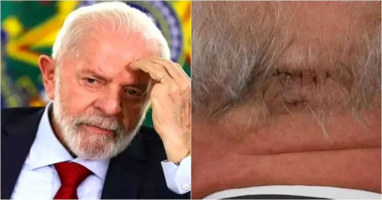 Lula passa por cirurgia intracraniana de emergência