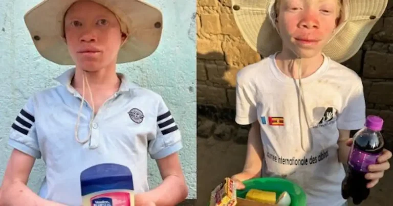 Misioneros ayudan a albinos perseguidos para rituales de brujería